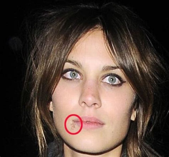 11 Celebrity with Cold Sores Last one is the Pretiest of all GenSupremo