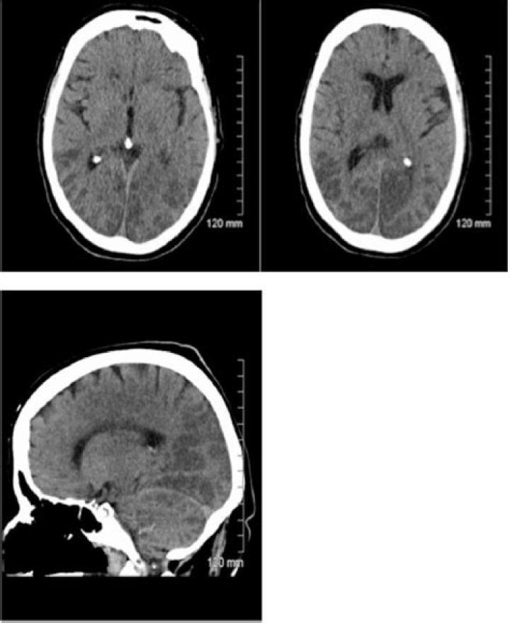 Anoxic brain injury CT and MRI patterns quick pictoral quide for