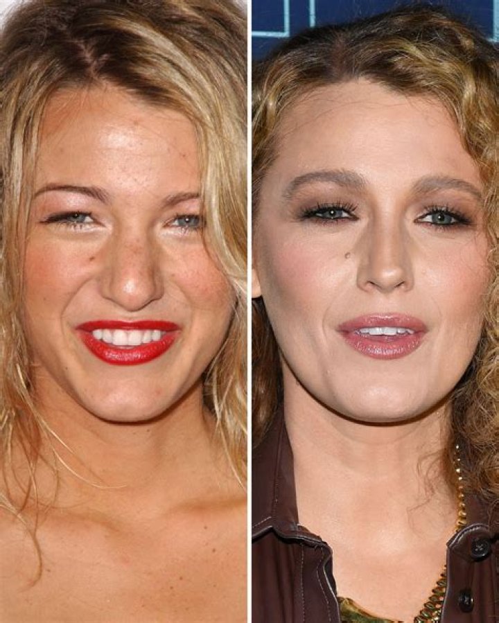 Blake Lively Before and After From 2005 to 2023 The Skincare Edit