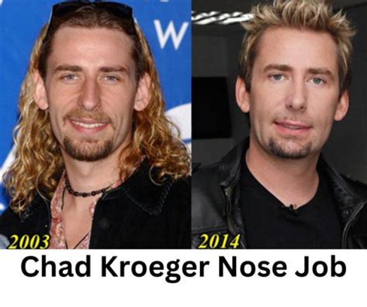 Chad Kroeger’s Nose Job: The Transformation Of A Rock Star