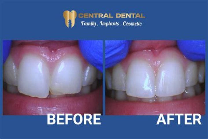 Chip Gaines Teeth Fixed Before And After Teeth Poster