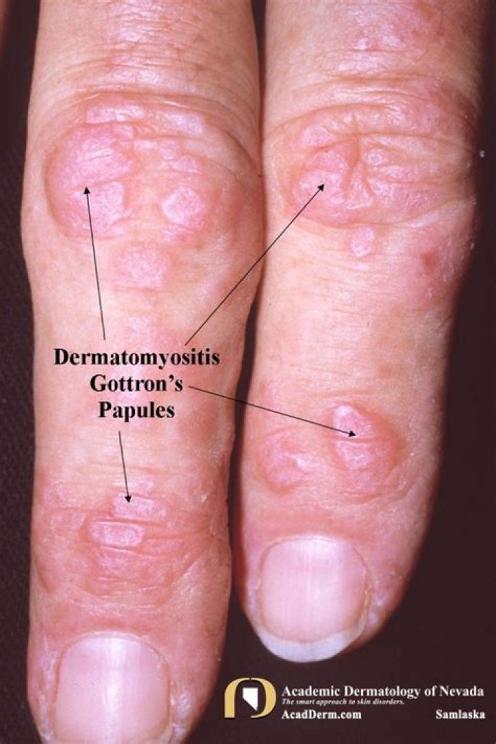 Dermatomyositis Flare Up Symptoms An identifying factor for