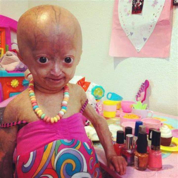Did Adalia Rose die? Wiki Age, Parents, Net Worth, Funeral, Family, Story