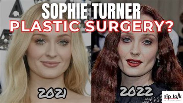 Did Sophie Turner Undergo Plastic Surgery Or Rumors? Learn All The