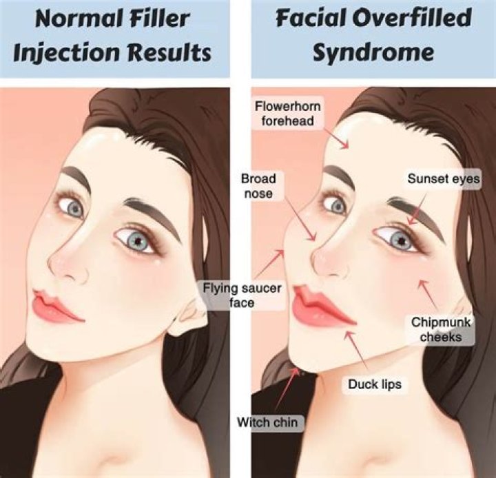 Dr Rachel Ho Fillers Gone Wrong Telltale Signs of Too Much Filler