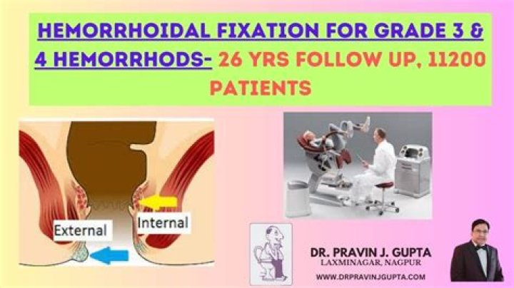 Exploring The Controversial Practice Of Hemorrhoid Piercing