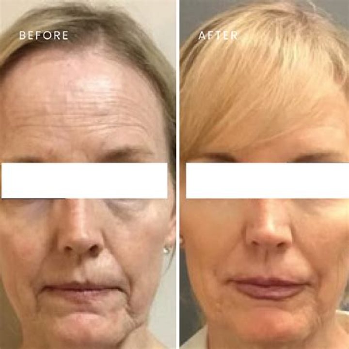 Facial Fillers Fab + Expensive How Many Syringes