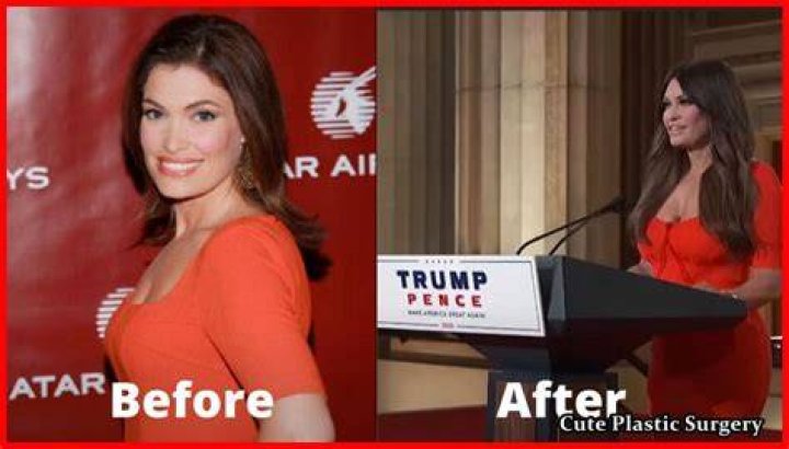 Has Kimberly Guilfoyle Undergone Breast Implants Celebrities Plastic