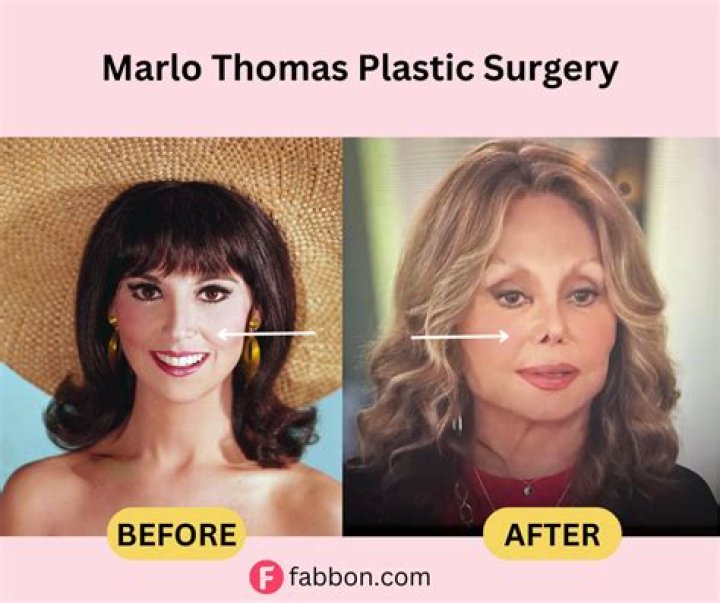Has Marlo Thomas Had Plastic Surgery? Transformation Photos Closer Weekly