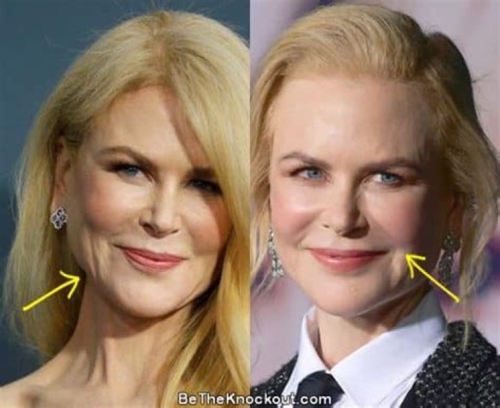 Has Nicole Kidman Had Breast Augmentation? Surgery Scrutiny And Truths