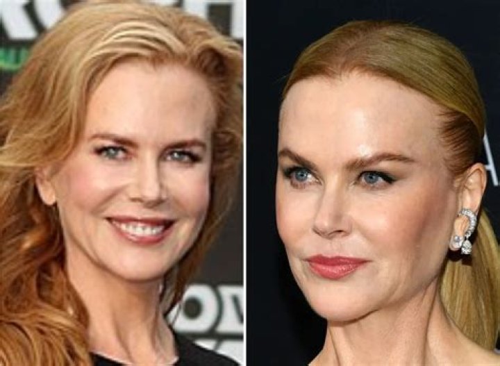 Has Nicole Kidman: Plastic Surgery Truth Revealed?