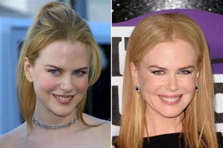 Hidden Truths About Nicole Kidman's Cosmetic Enhancements