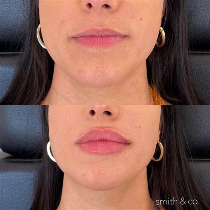 How Long Does Two-Faced Lip Injections Really Last? Find Out Here