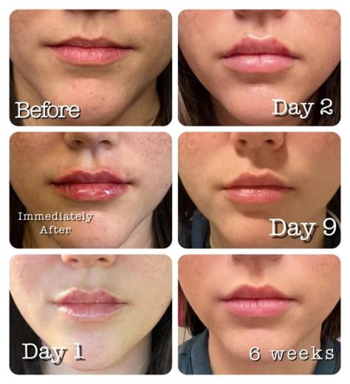 How Soon After Lip Injections Can You Get More? GA Fashion