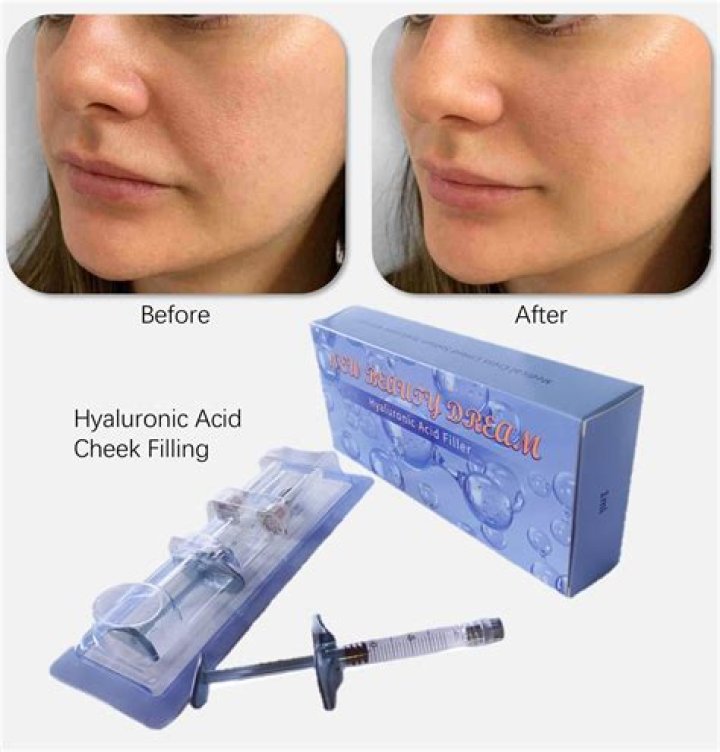 Hyaluronic Acid Dermal Filler 💉 Although all hyaluronic acid dermal