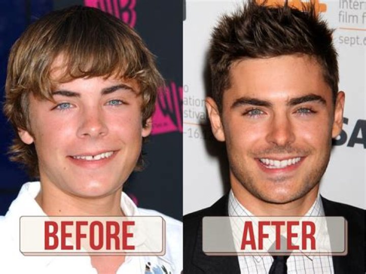 &iquest;Exceso de b&oacute;tox? Zac Efron recibe duras cr&iacute;ticas tras radical cambio