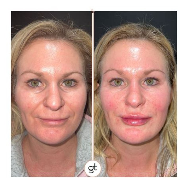 Julia Fox's Lip Fillers: Transformation, Controversy, And Beyond