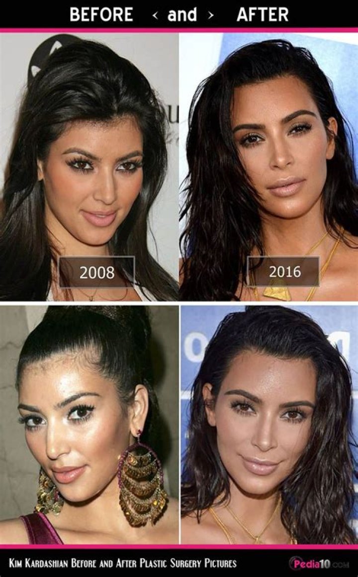 Kim Kardashian Plastic Surgery Before and After Transformations