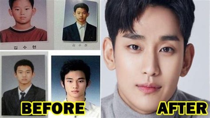 Kim Soo Hyun Plastic Surgery Before After