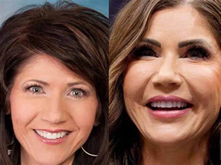 Kristi Noem's Plastic Surgery Transformation: Before And After