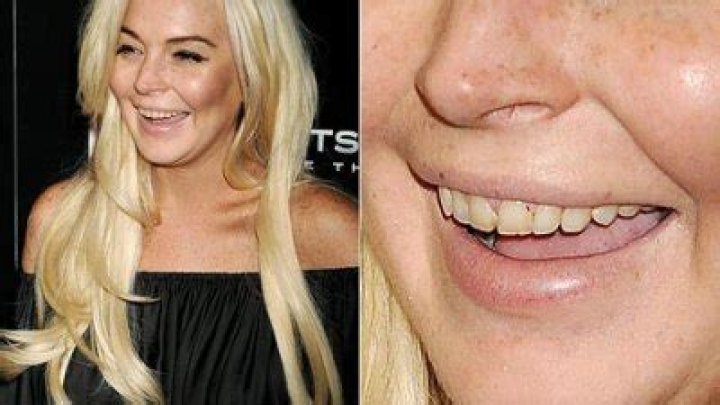 Lindsay Lohan Flashes Yellow, Decayed Teeth on Red Carpet Us Weekly