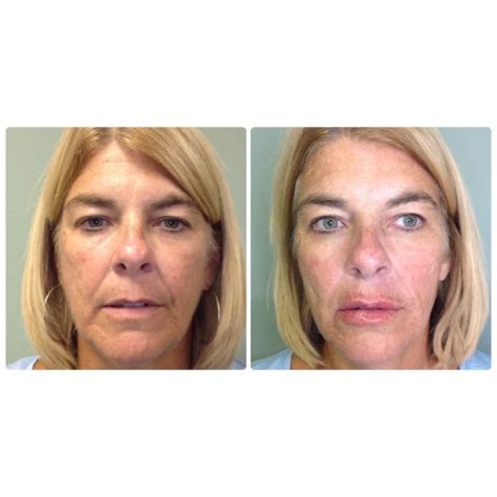 Liquid Face Lift using Juvederm Dermal fillers, Beautiful face