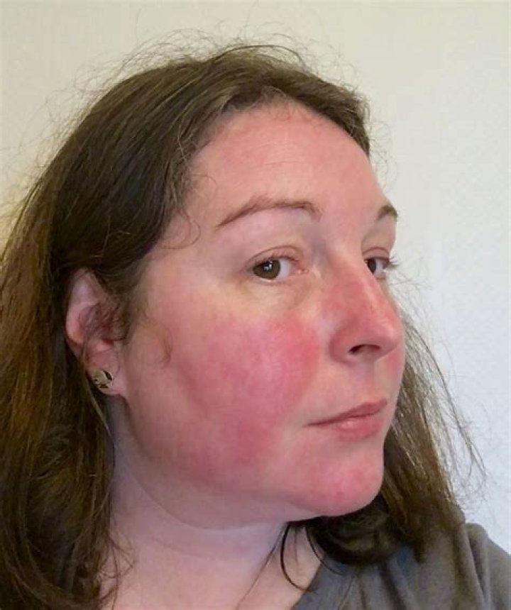 Lupus can cause a red butterflyshaped rash across the nose and cheeks