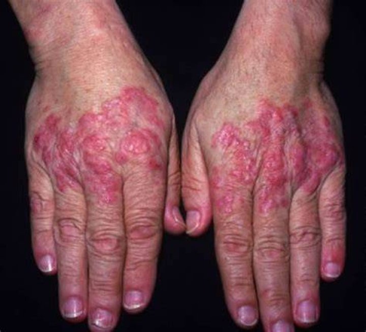 Lupus Systemic Lupus Erythematosus (SLE) Causes, Sign & Symptoms