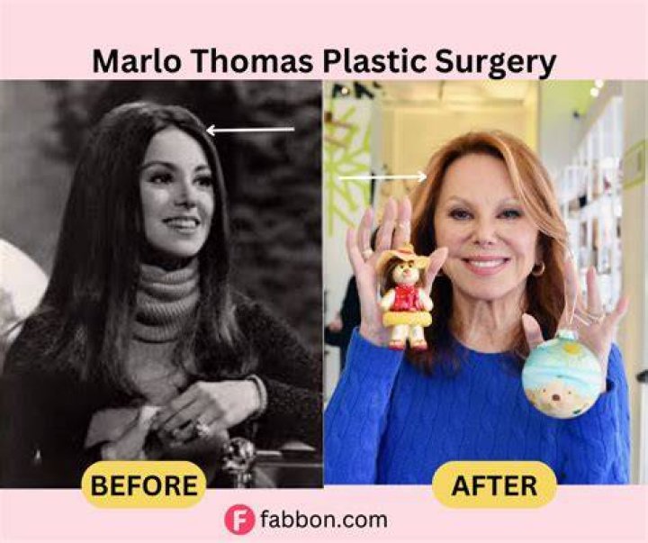Marlo Thomas Botox Did She Have A Facelift? Her Before And After