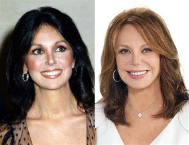 Marlo Thomas Plastic Surgery Before and After Photos