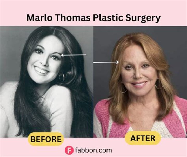 Marlo Thomas Plastic Surgery Secrets Before And After Photos Fabbon