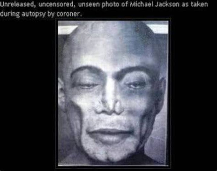 Michael Jackson Post mortem reveals 13 puncture marks on his body