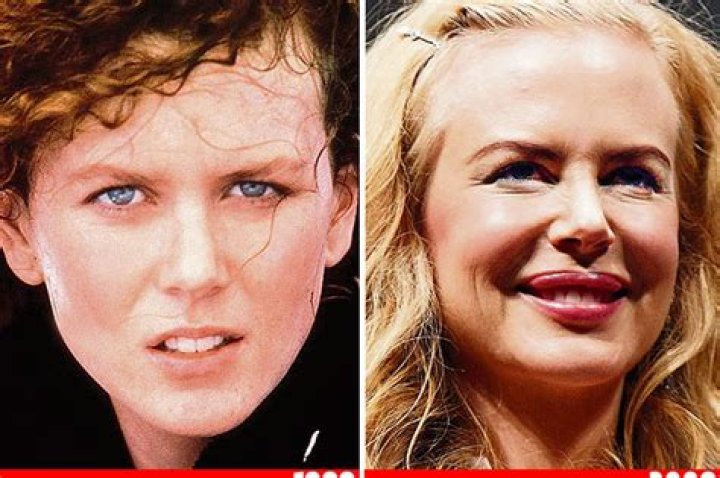 nicole kidman Botched Plastic Surgery, Bad Plastic Surgeries, Plastic