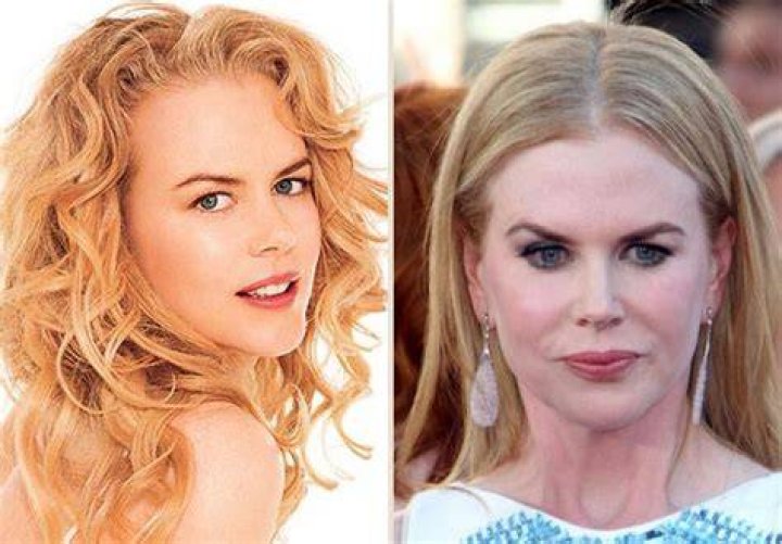 Nicole Kidman Breast Implants Plastic Surgery Before and After Celebie