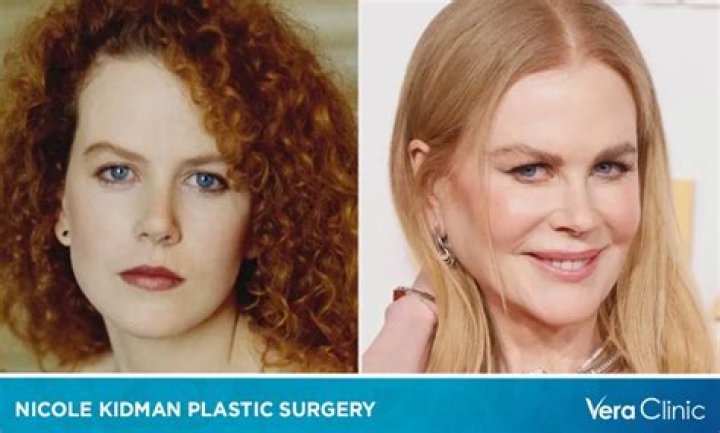 Nicole Kidman plastic surgery row 'She's ruined herself' Daily Star