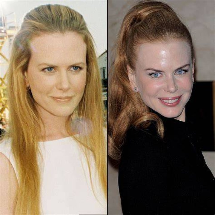 Nicole Kidman's Plastic Surgery What Changes Did She Make? IWMBuzz