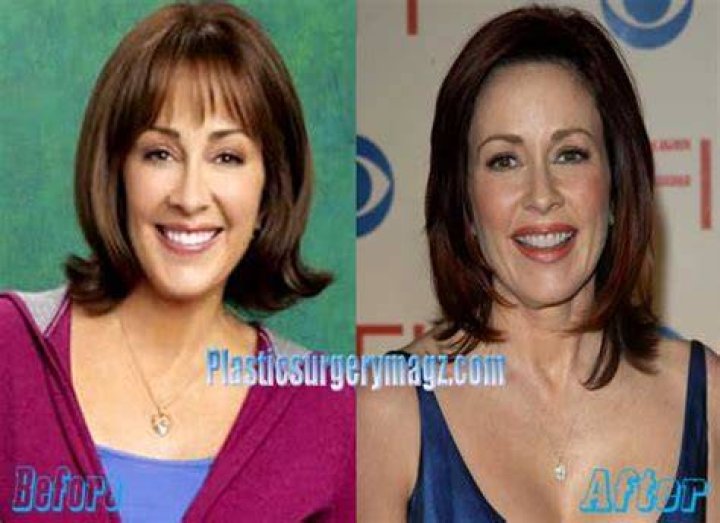 Patricia Heaton Breast Reduction Plastic Surgery Before And After