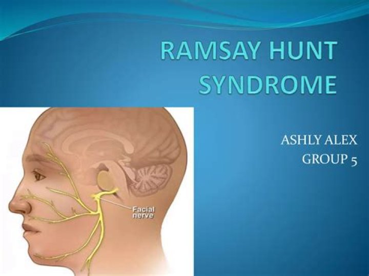 Ramsay Hunt Syndrome Therapy