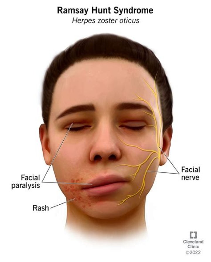Ramsay Hunt Syndrome