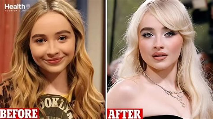 Sabrina Carpenter's Plastic Surgery: Transformation And Procedures