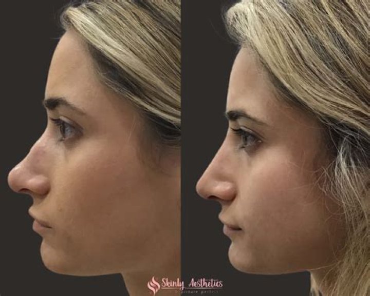 Savrina Carpenter's Nose Job: A Transformation Journey