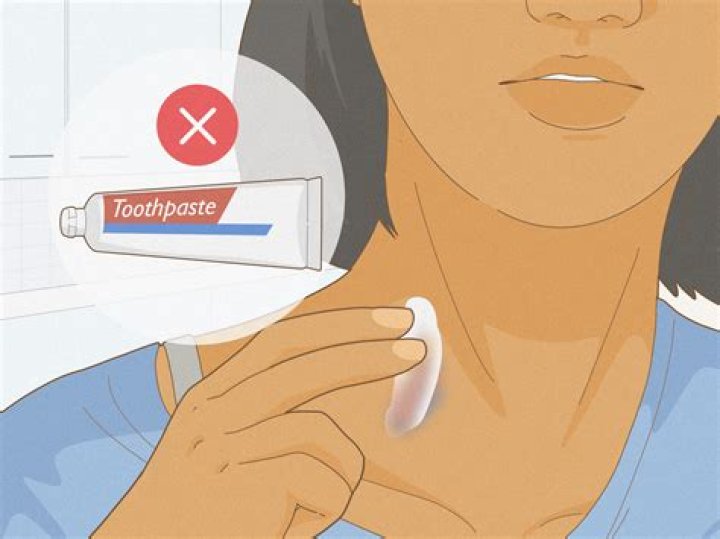 Say Goodbye To Hickeys: Effective Ways To Get Rid Of Them