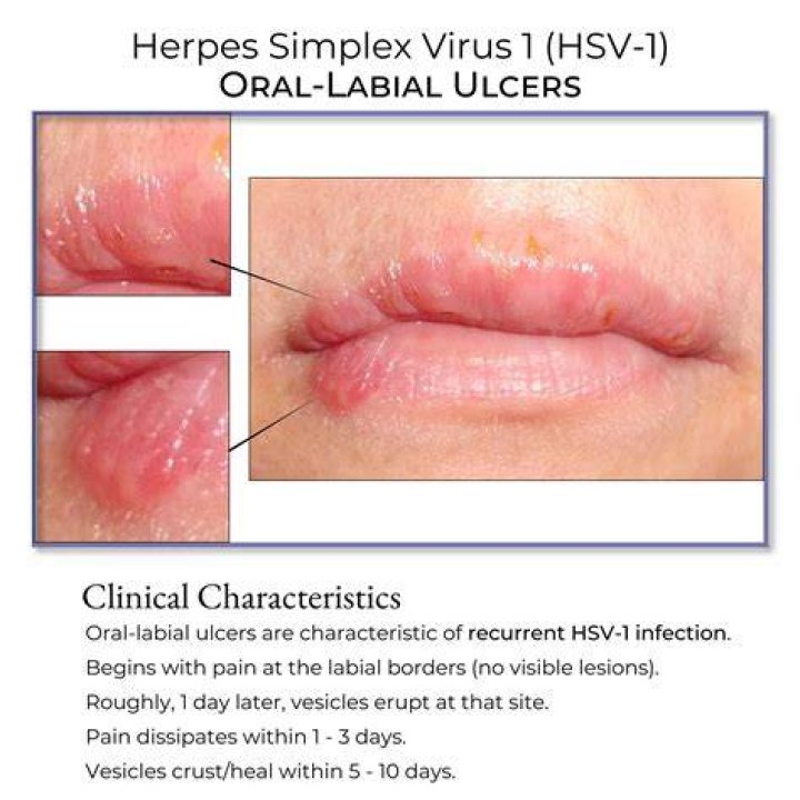 So, Usher Has Herpes &mdash; But So Does 15 Percent of America Allure