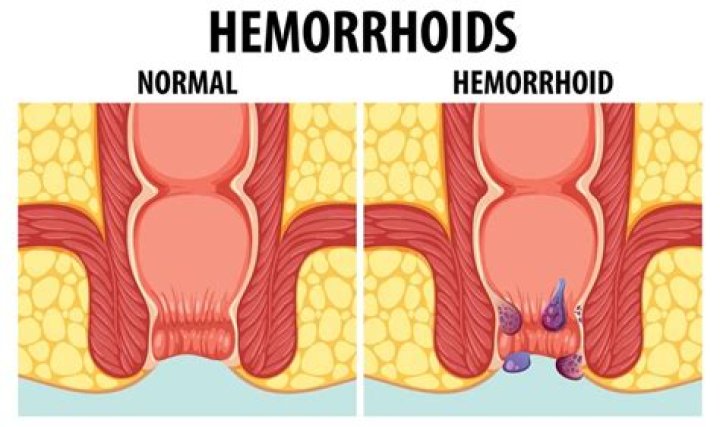 The 49+ Hemorrhoid Piercing Images APKMODY