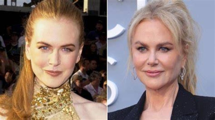 The Unfiltered Truth About Nicole Kidman's Plastic Surgery Journey