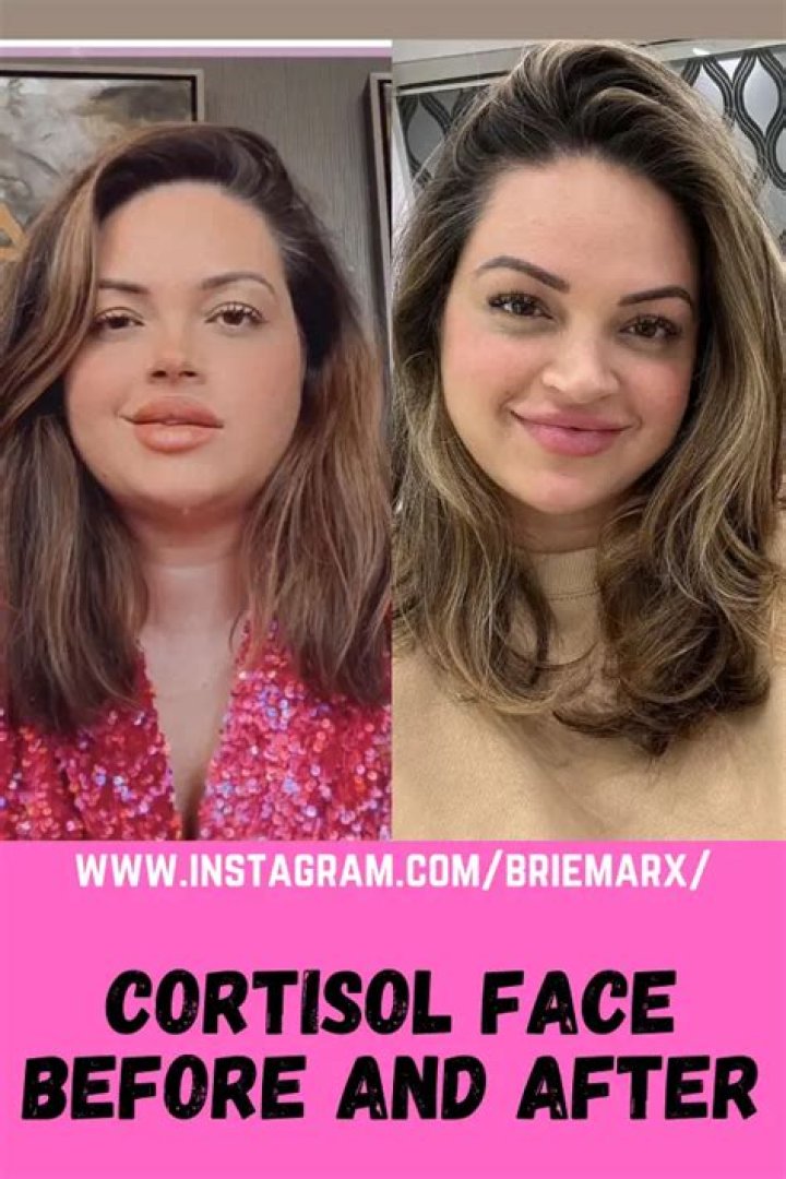 Transformations Of The Face: Before And After High Cortisol Levels