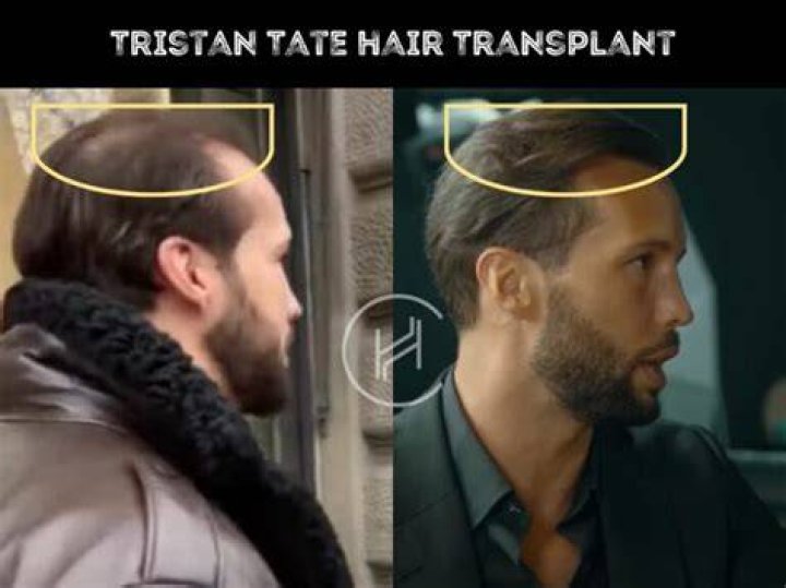Tristan Tate Hair Transplant His Announcement Shocks All!