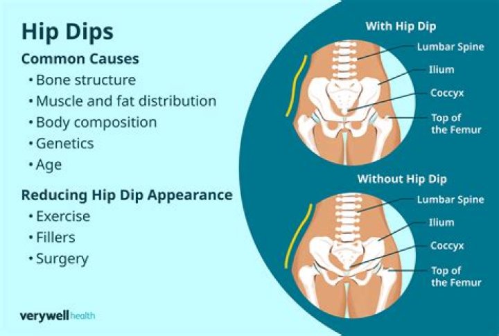 Understanding The Enigma Of Hip Dips: What Causes Hip Dips?