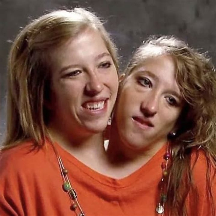 Unraveling The Mystery: Are Conjoined Twins Abby And Brittany Dead?