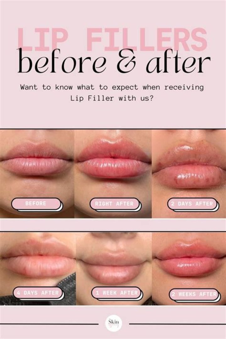 Unveiling The Truth Behind Maura Tierney's Lip Filler Journey